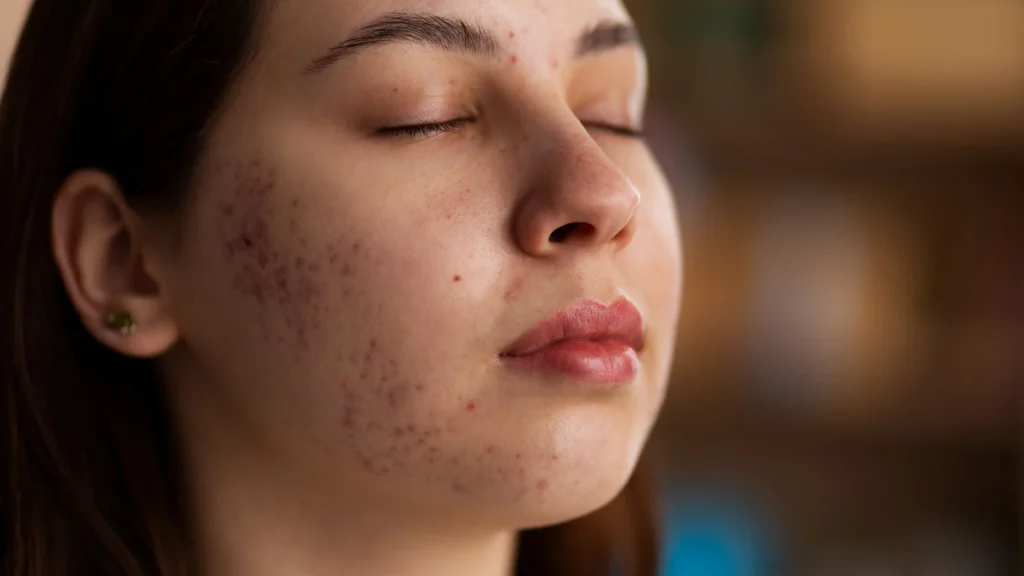 Acne-Skin