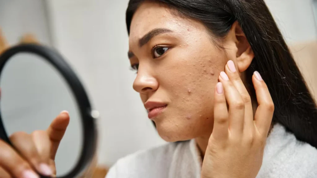 Top-Skinfluencers-to-Follow-for-Real-Acne-Inspiration